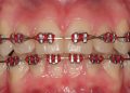 Red Braces