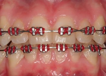 Red Braces
