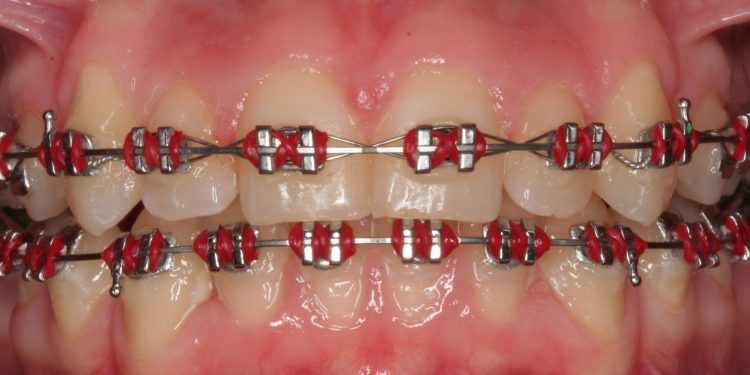 Red Braces