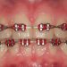 Red Braces