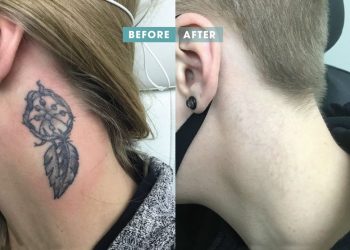 Tattoo Removal