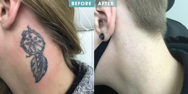 Tattoo Removal