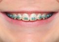 Blue Braces