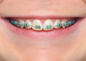 Blue Braces