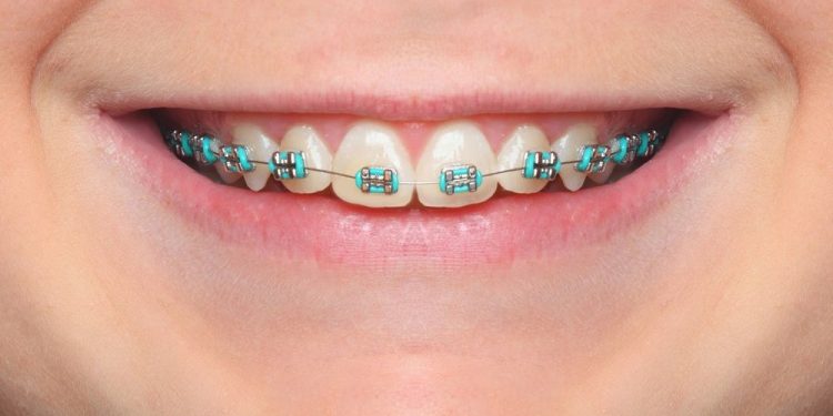 Blue Braces