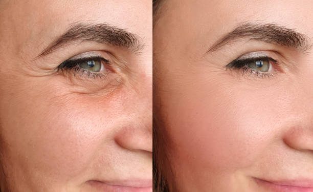 Botox Before and After Eyes