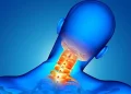 Cervical Radiculopathy ICD 10