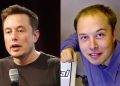 Elon Musk Hair Transplant