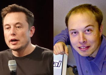 Elon Musk Hair Transplant