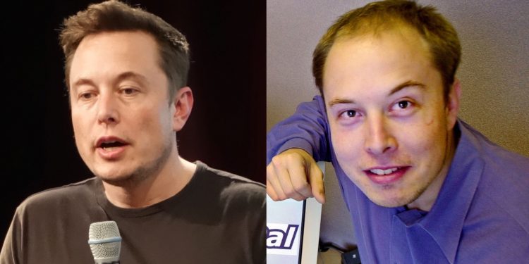 Elon Musk Hair Transplant