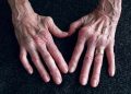 ICD-10 Codes for Rheumatoid Arthritis