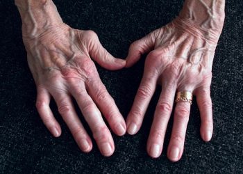 ICD-10 Codes for Rheumatoid Arthritis