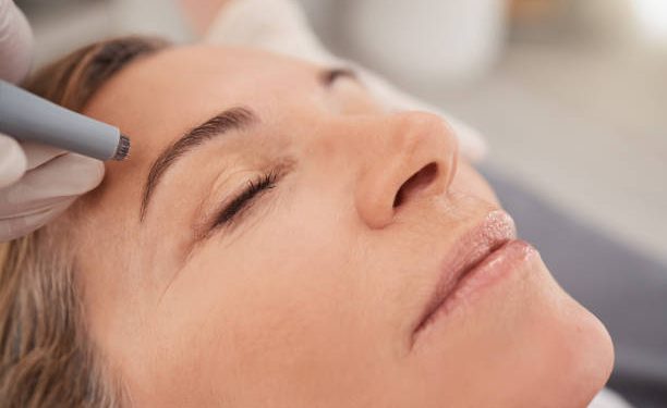 Skin Needling