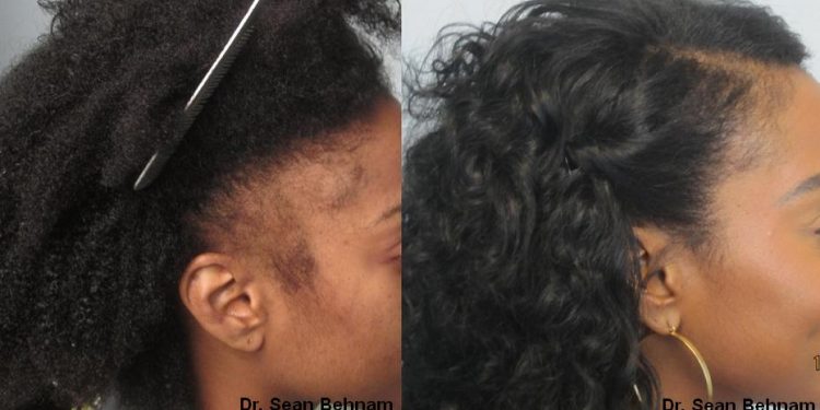 Hair Restoration For African American Patients – What You Need to Know