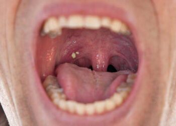 Can Tonsils Grow Back After Being Removed? – Tymoff, An In-Depth Analysis