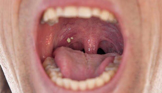 Can Tonsils Grow Back After Being Removed? – Tymoff, An In-Depth Analysis