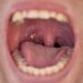 Can Tonsils Grow Back After Being Removed? – Tymoff, An In-Depth Analysis