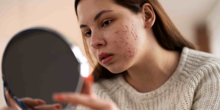 Acne Prevention: Stress, Diet, Exercise, Sleep, and More