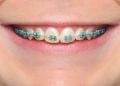 Blue Braces