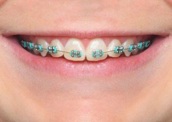 Blue Braces