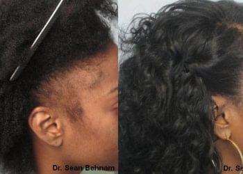 Hair Restoration For African American Patients – What You Need to Know